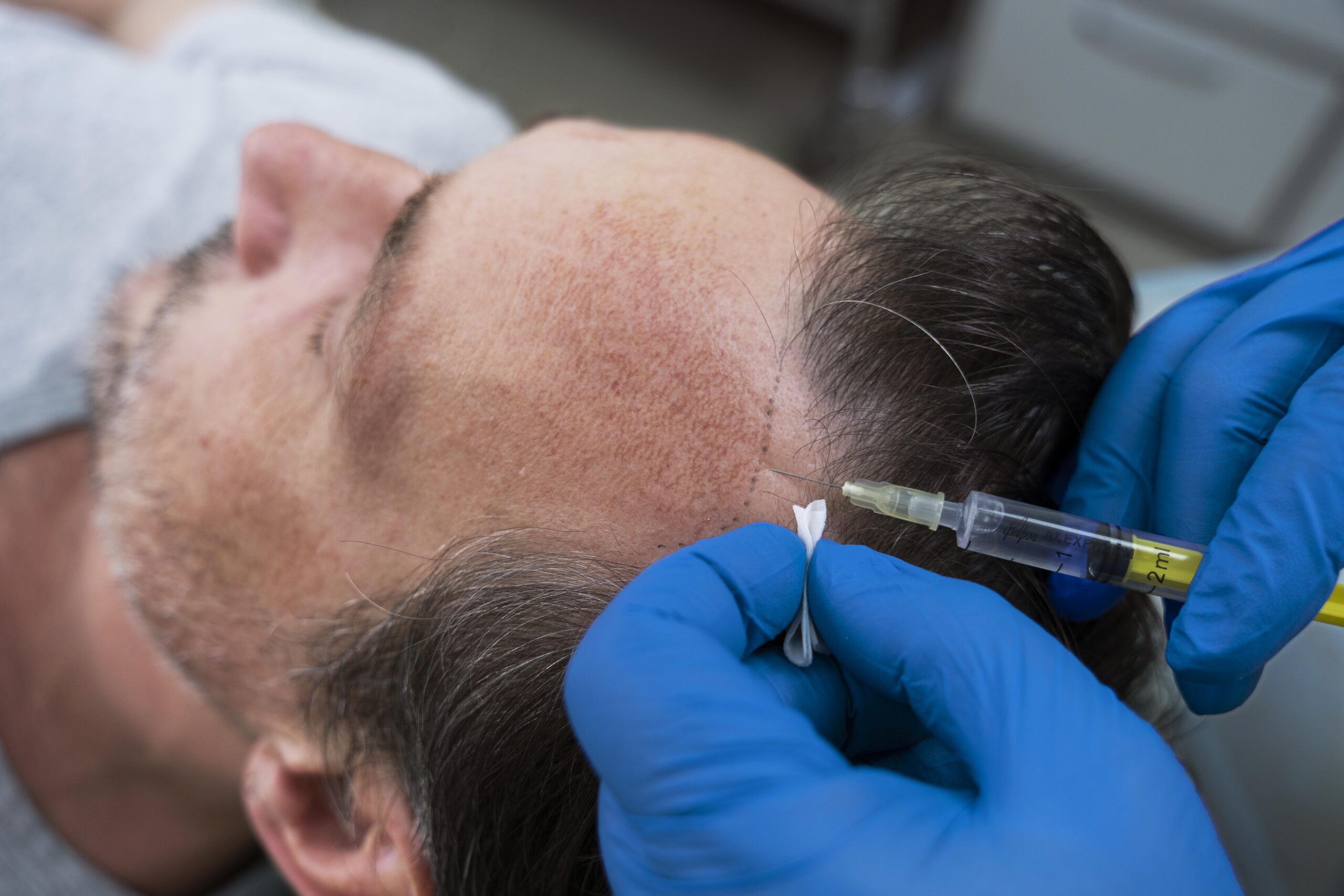 man-getting-hair-loss-treatment