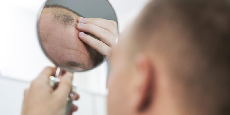 adult-male-having-balding-problems (1)